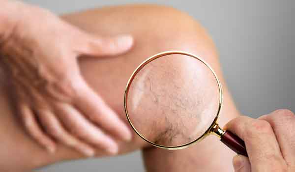 Ein Arzt untersucht mit einer Lupe ein Bein für die Früherkennung von Thrombosen.